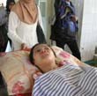 Anak Lumpuh Korban Suntik Dokter Jalani Fisioterapi